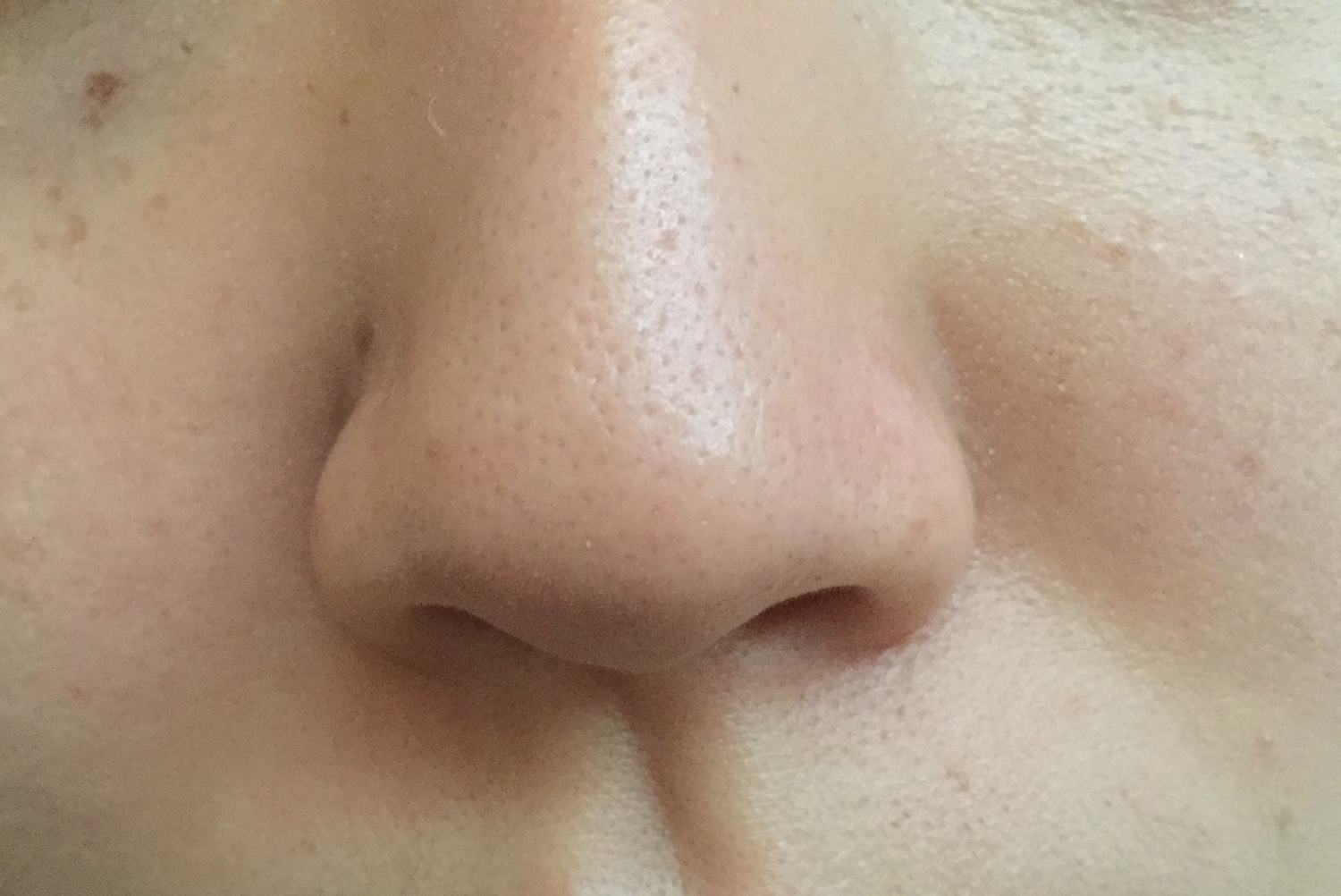 イチゴ鼻の原因と改善のための正しいケア方法